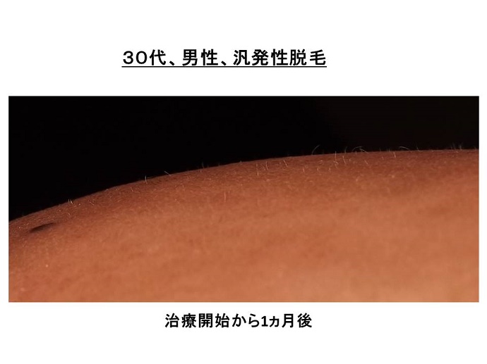 円形脱毛症　病院""